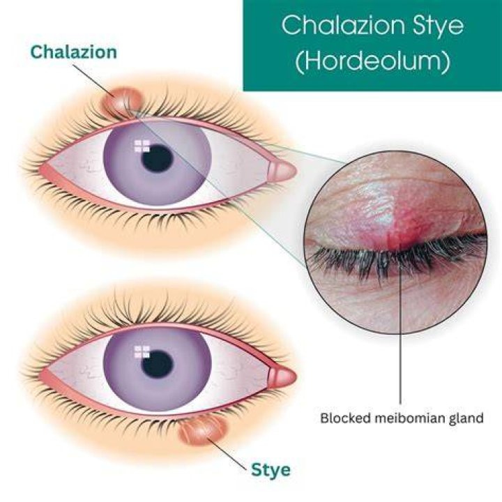Do styes become Chalazions? | ContextResponse.com
