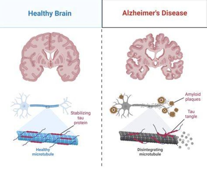Does Teflon cause Alzheimer's?