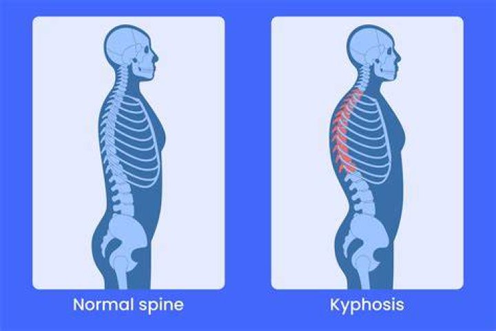 How do you know if you have kyphosis?