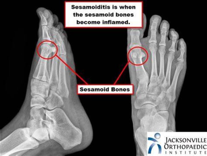What are sesamoid bones? | ContextResponse.com