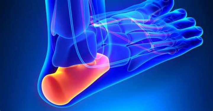 What happens if plantar fasciitis is left untreated?